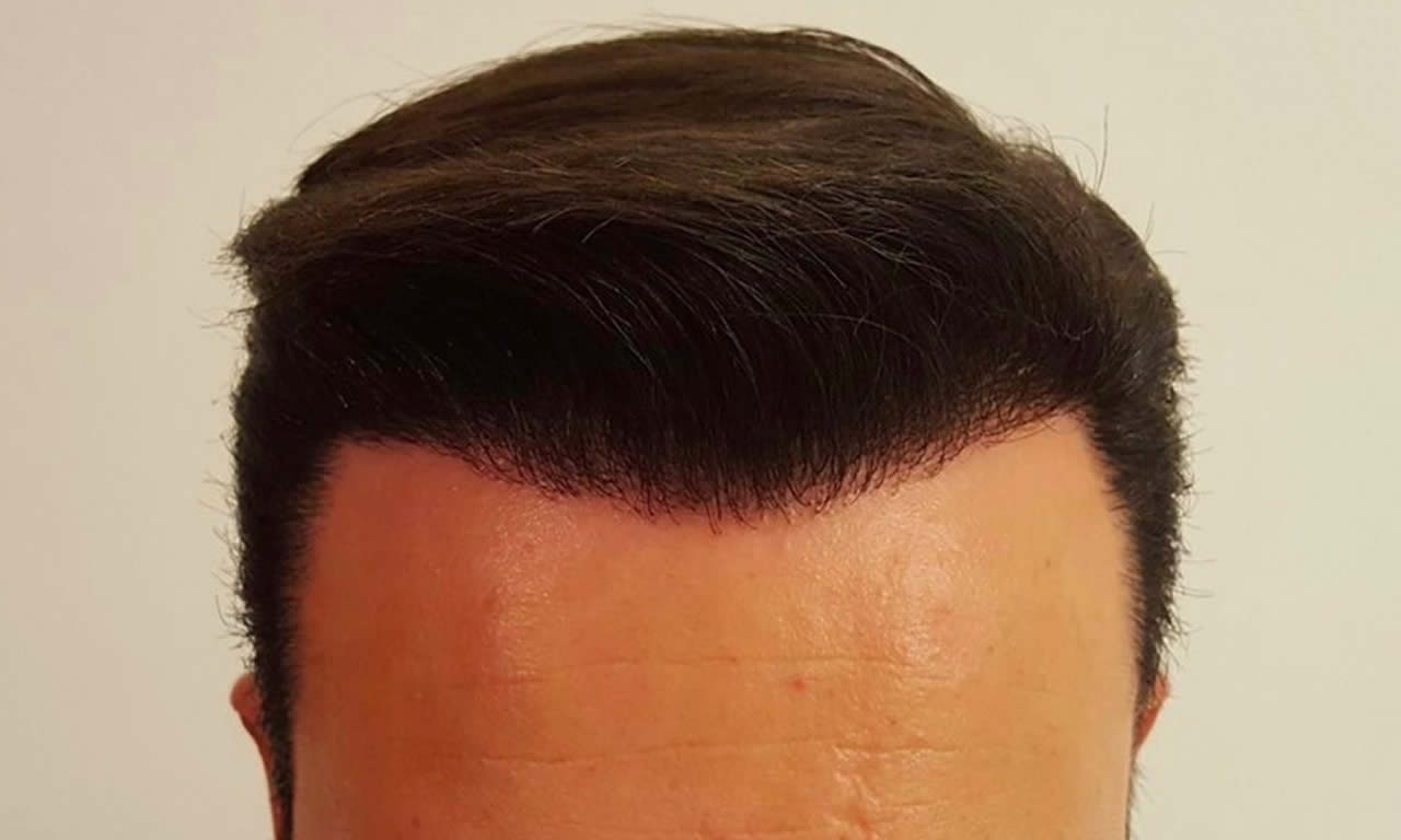 Farklı Saç Ekimi Çeşitleri Var mı? Hangi Prosedür Sizin İçin İdeal?