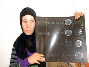 8 yıldır kafasındaki kurşunlarla yaşıyor