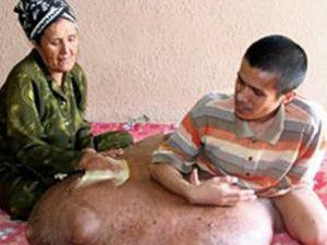 Bacağında 90 kilo tümör var!