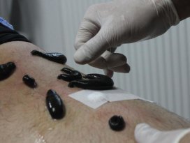 Sülük tedavisinde hepatit uyarısı