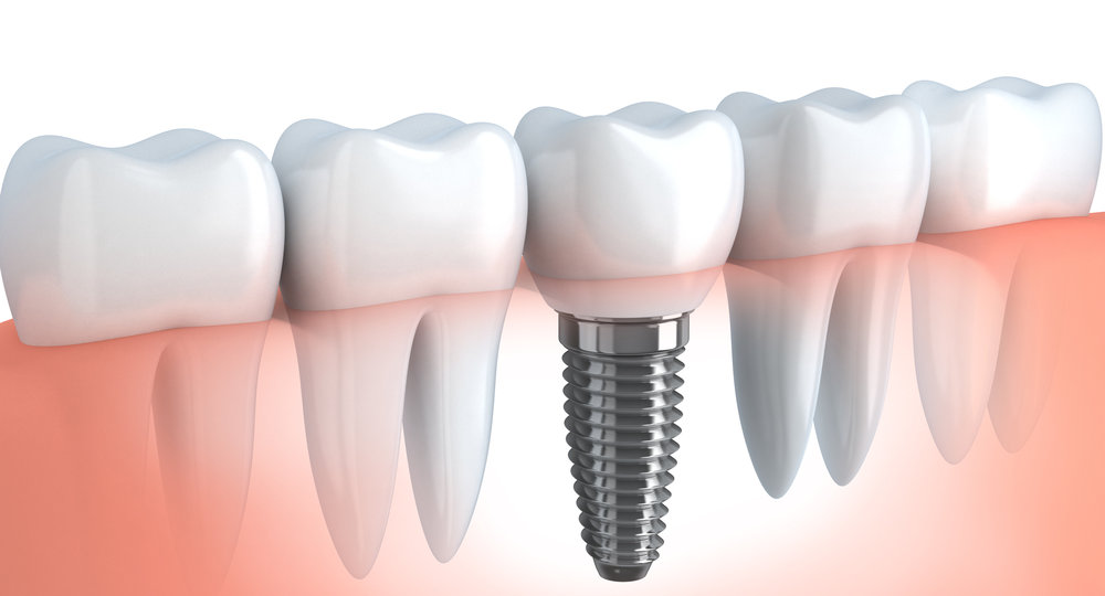 dis-implanti-dental-implant-thegem-blog-default.jpg